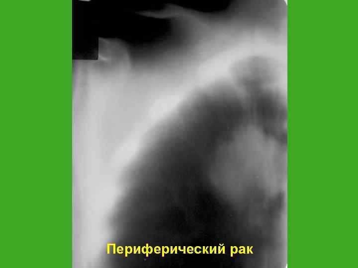 Периферический рак 