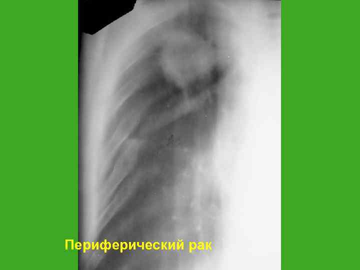 Периферический рак 