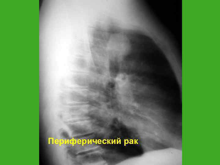 Периферический рак 
