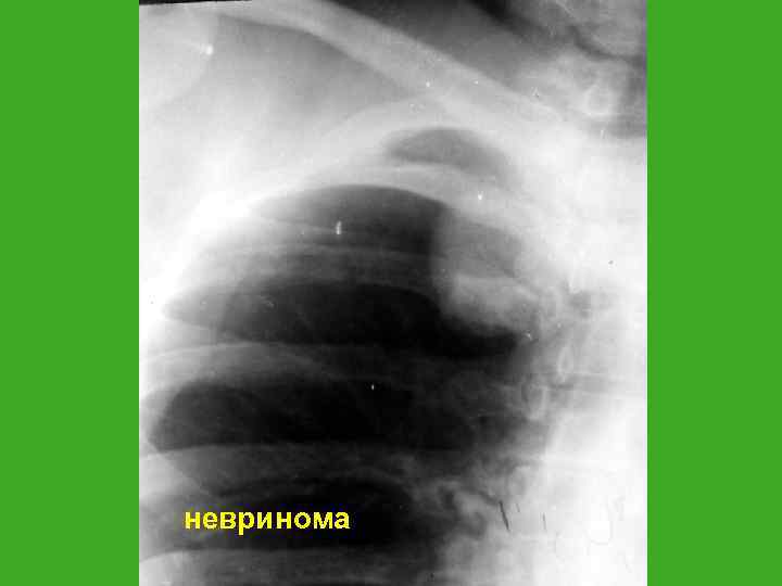 невринома 