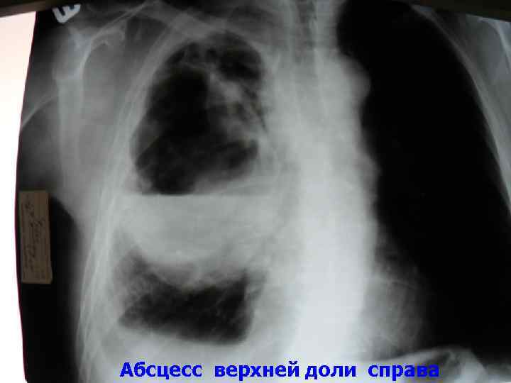 Абсцесс верхней доли справа 