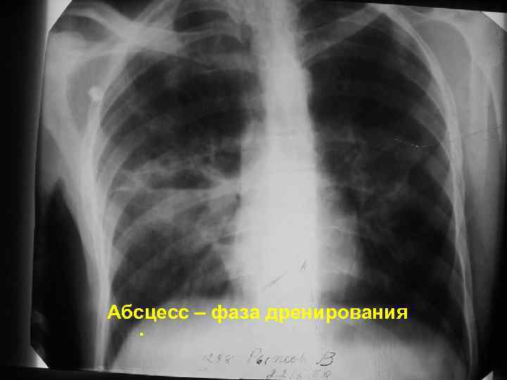 Абсцесс – фаза дренирования. 