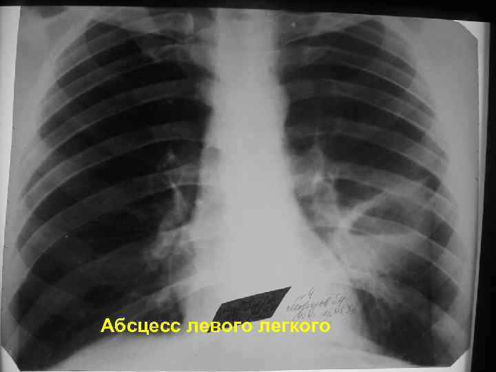 Абсцесс левого легкого 