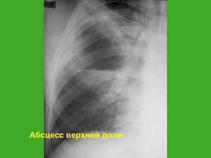 Абсцесс верхней доли 