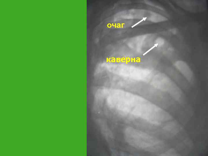 очаг каверна 