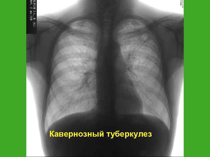 Кавернозный туберкулез 