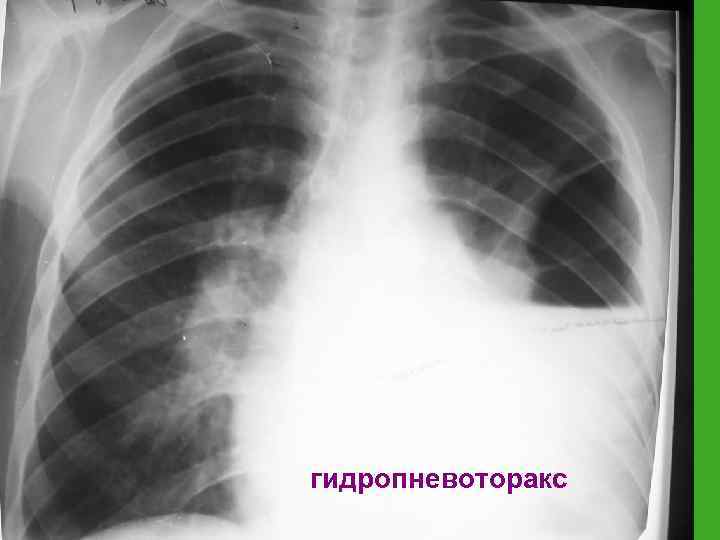 гидропневоторакс 
