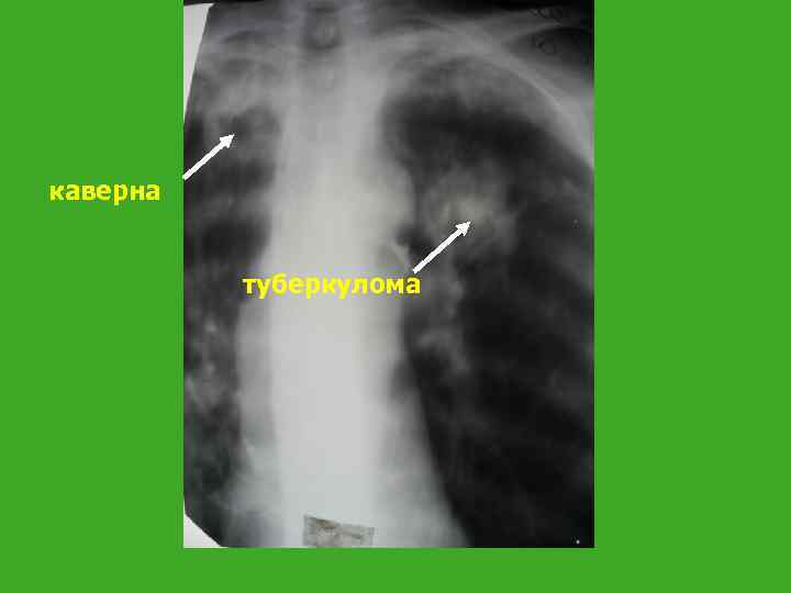 каверна туберкулома 