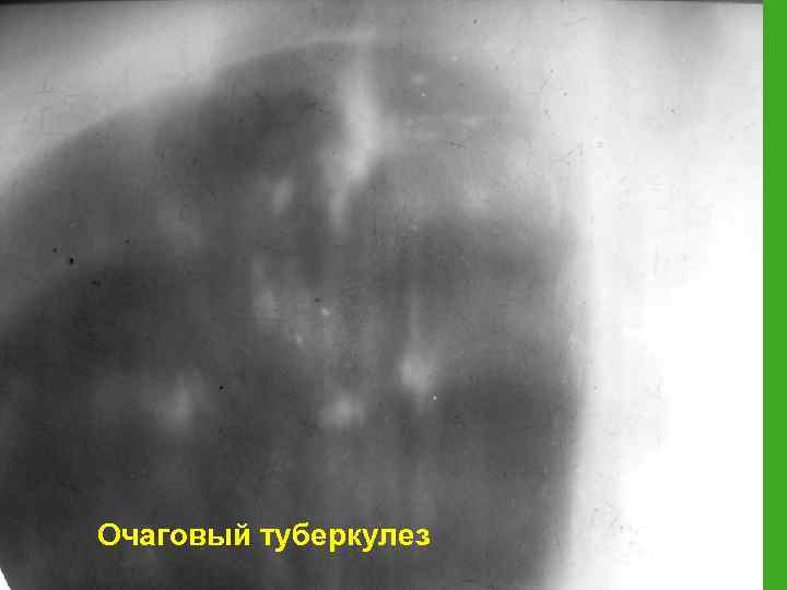 Очаговый туберкулез 