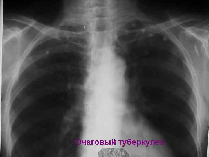 Очаговый туберкулез 