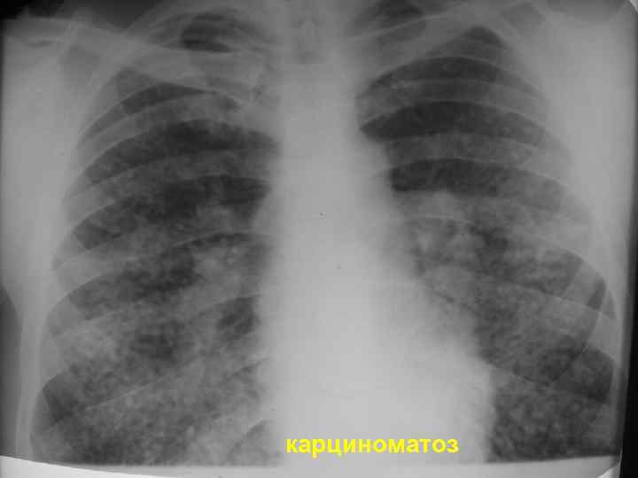 карциноматоз 