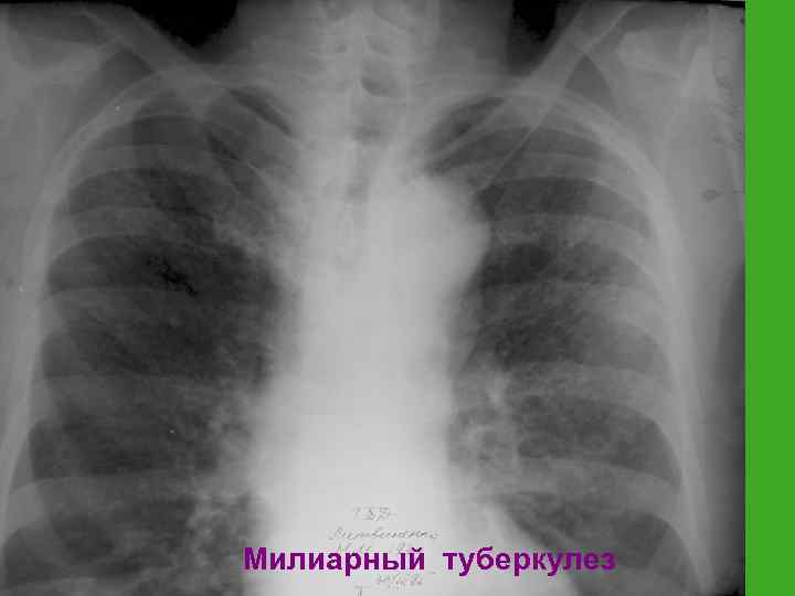 Милиарный туберкулез 