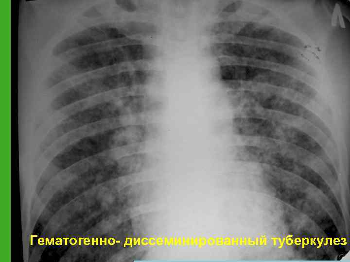 Гематогенно- диссеминированный туберкулез 
