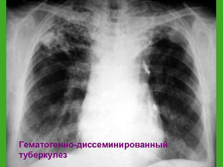Гематогенно-диссеминированный туберкулез 