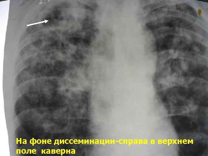 н На фоне диссеминации-справа в верхнем поле каверна 