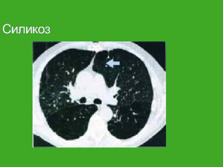 Силикоз 
