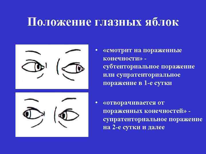 Положение глазных яблок • «смотрит на пораженные конечности» субтенториальное поражение или супратенториальное поражение в