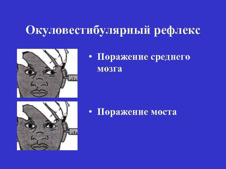 Окуловестибулярный рефлекс • Поражение среднего мозга • Поражение моста 