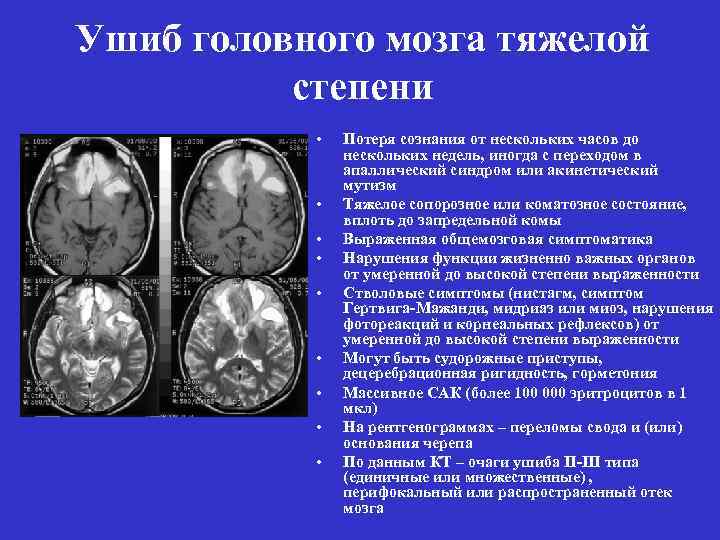 3 сотрясения мозга. Ушиб головного мозга тяжелой степени симптомы. Черепно мозговая травма кт и мрт. Субдуральная гематома ушиб головного мозга, степень тяжести.
