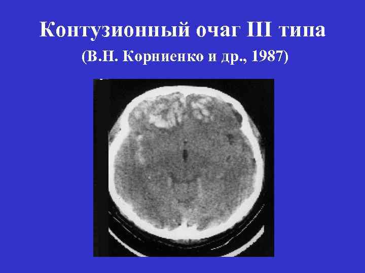 Что значит очаг в головном мозге. Контузионный очаг в головном мозге. Контузионные очаги головного мозга на кт. Ушиб головного мозга 1 типа кт.
