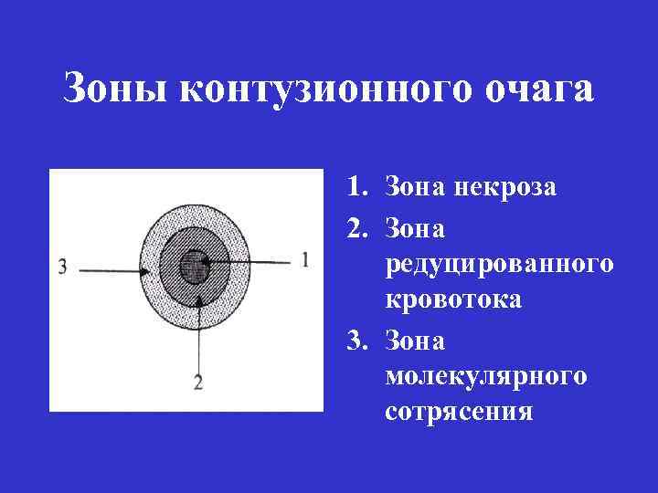 Зоны контузионного очага 1. Зона некроза 2. Зона редуцированного кровотока 3. Зона молекулярного сотрясения