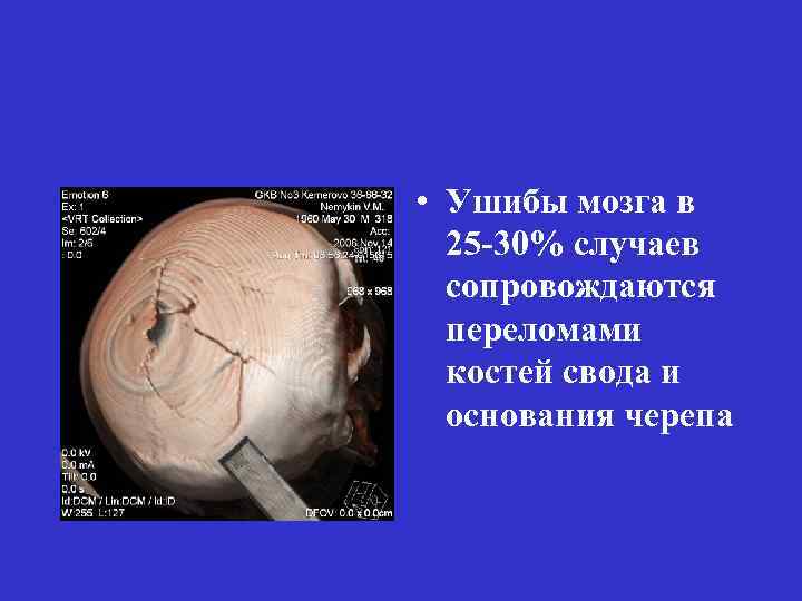  • Ушибы мозга в 25 -30% случаев сопровождаются переломами костей свода и основания