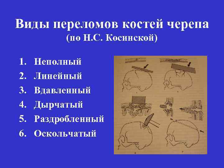 Виды переломов костей черепа (по Н. С. Косинской) 1. 2. 3. 4. 5. 6.