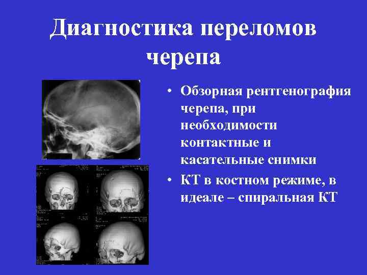 Диагностика переломов черепа • Обзорная рентгенография черепа, при необходимости контактные и касательные снимки •