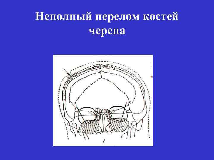 Карта вызова смп перелом основания черепа