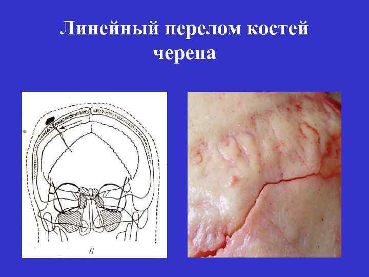 Линейный перелом костей черепа 