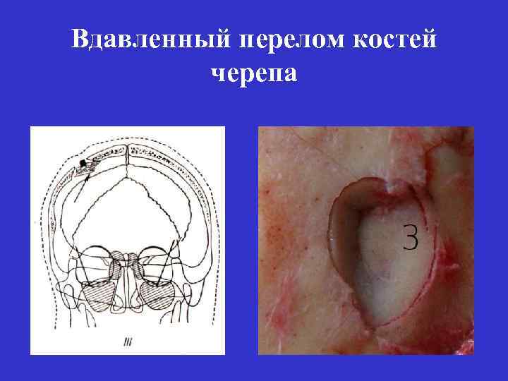 Вдавленный перелом костей черепа 