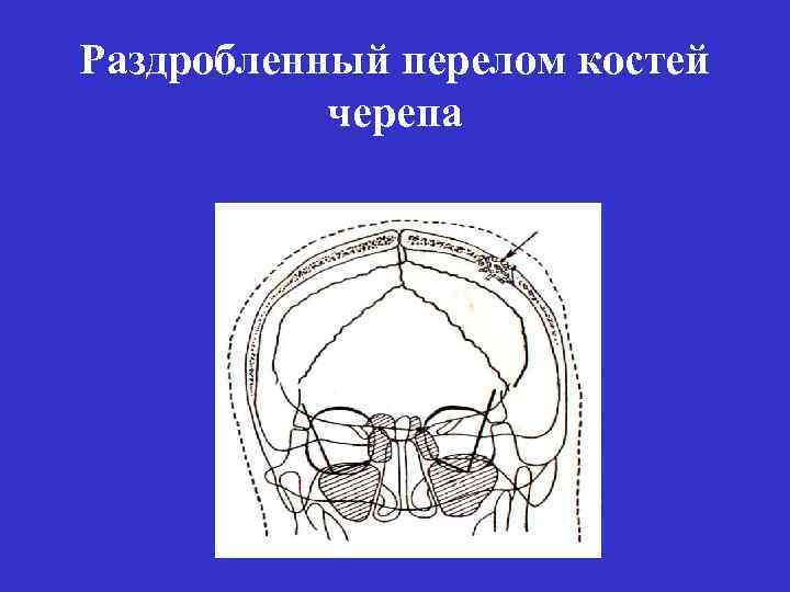 Раздробленный перелом костей черепа 