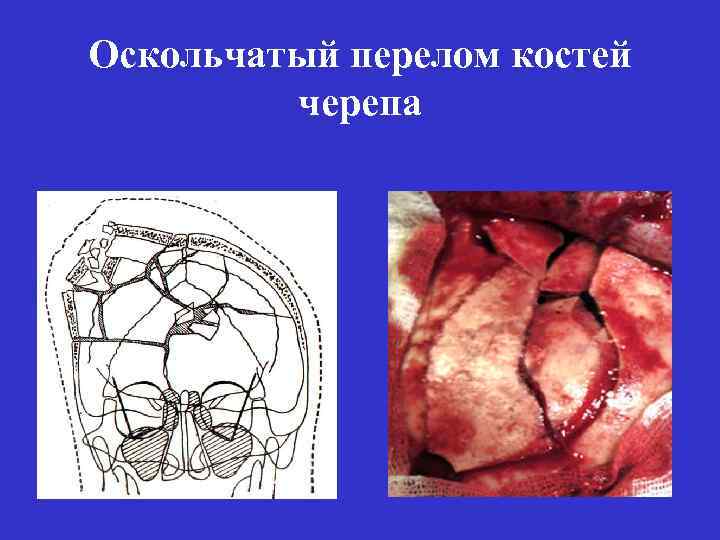 Оскольчатый перелом костей черепа 