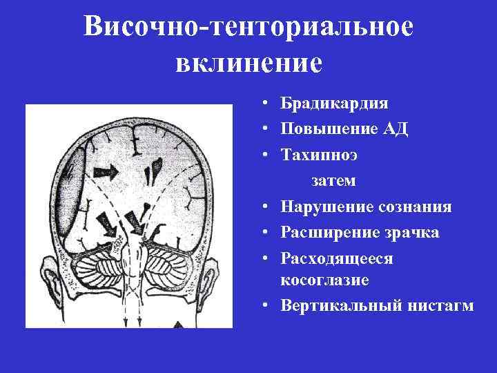 Височно-тенториальное вклинение • Брадикардия • Повышение АД • Тахипноэ затем • Нарушение сознания •