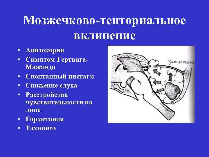 Мозжечково-тенториальное вклинение • Анизокория • Симптом Гертвига. Мажанди • Спонтанный нистагм • Снижение слуха