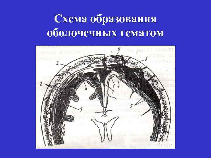 Схема образования оболочечных гематом 