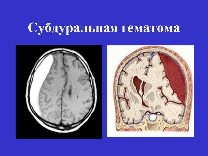 Субдуральная гематома 