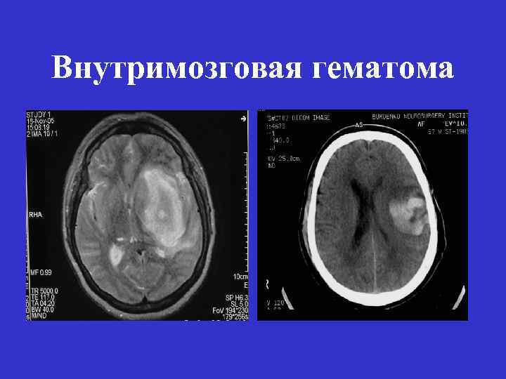 Гематома черепно мозговой травме. Хроническая внутримозговая гематома на кт. Внутримозговая гематома мрт. Кт внутримозговая гематома головного мозга. Кт внутримозговая гематома ОЧМТ.
