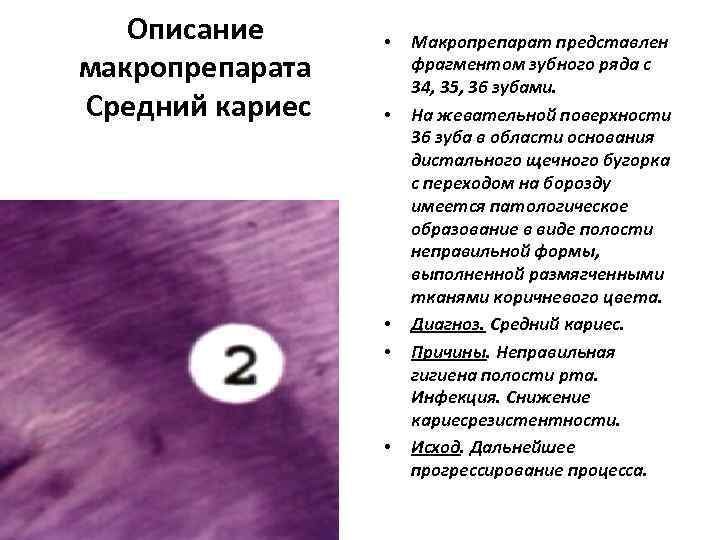   Описание  •  Макропрепарат представлен макропрепарата  фрагментом зубного ряда с
