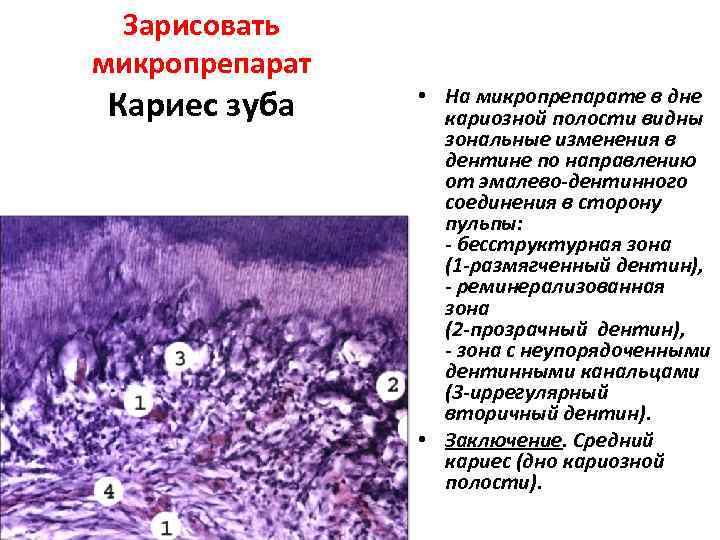  Зарисовать микропрепарат Кариес зуба • На микропрепарате в дне    кариозной