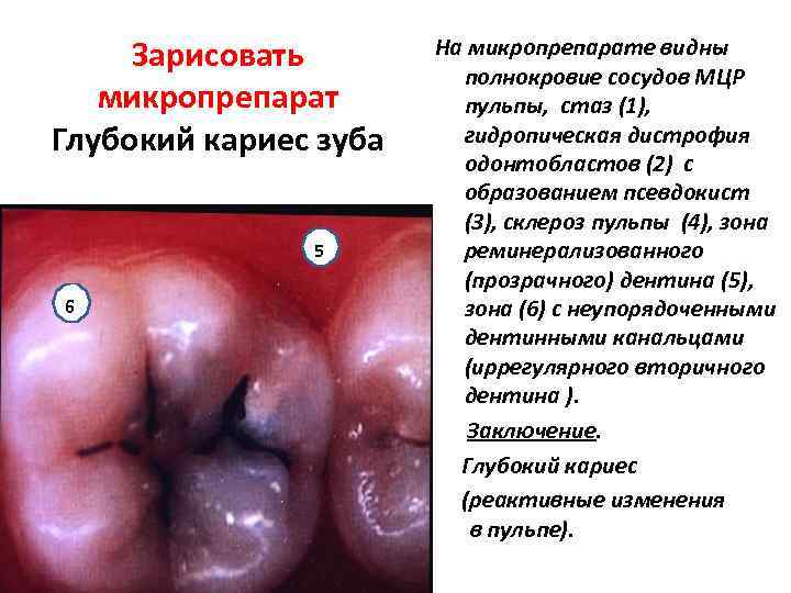  Зарисовать   На микропрепарате видны      полнокровие сосудов