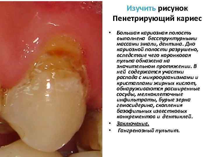   Изучить рисунок Пенетрирующий кариес • Большая кариозная полость  выполнена бесструктурными 