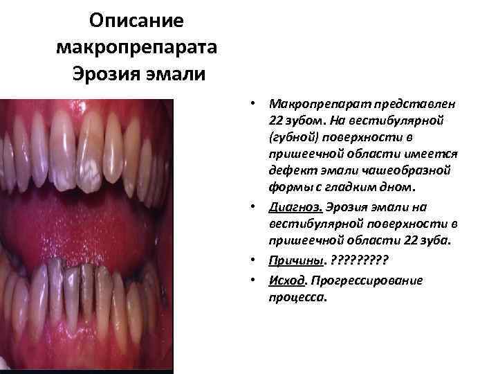  Описание макропрепарата  Эрозия эмали    • Макропрепарат представлен 