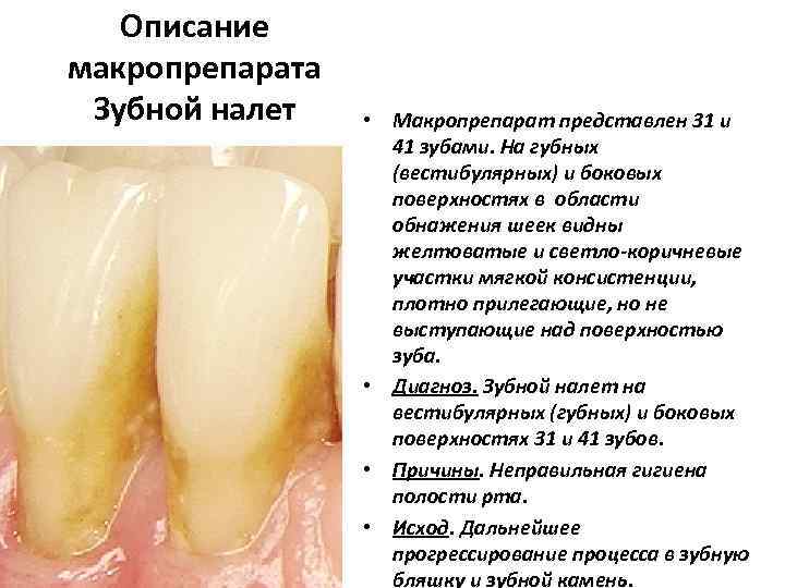   Описание макропрепарата Зубной налет • Макропрепарат представлен 31 и   
