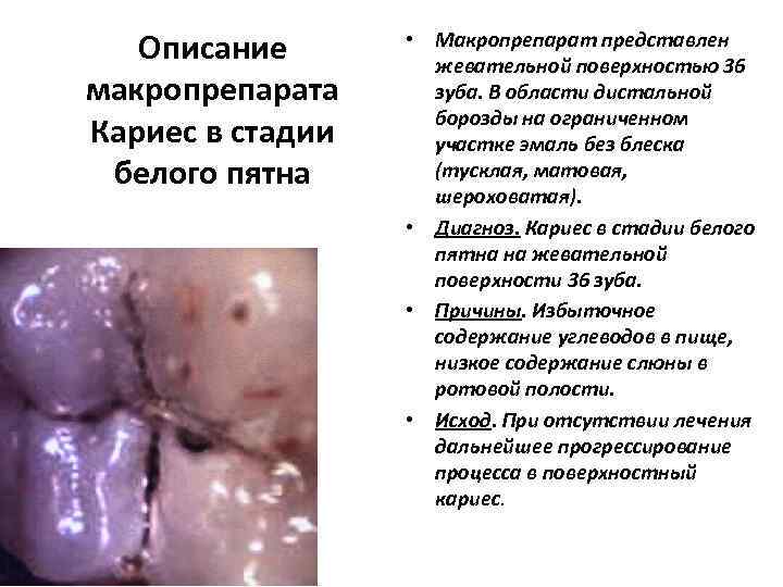   Описание   • Макропрепарат представлен     жевательной поверхностью