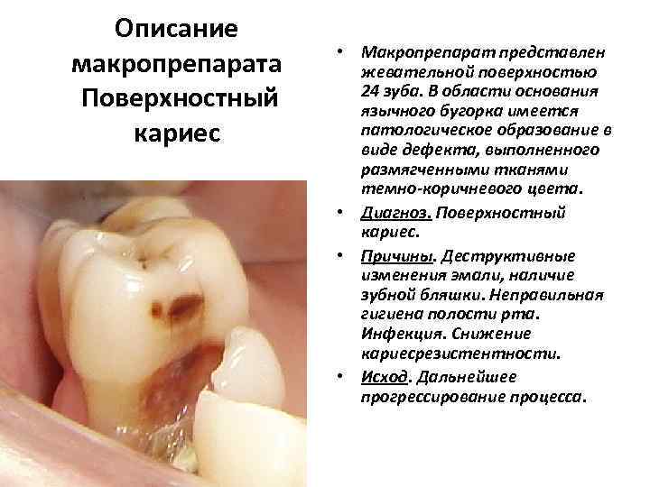   Описание     • Макропрепарат представлен макропрепарата жевательной поверхностью Поверхностный