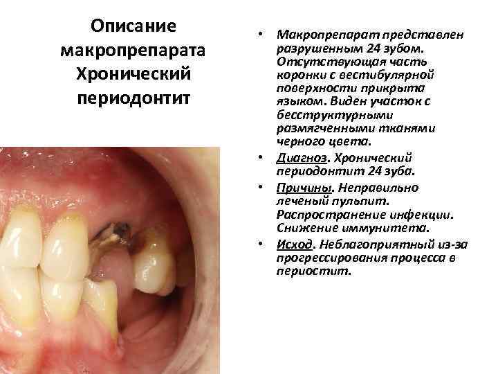   Описание  • Макропрепарат представлен макропрепарата разрушенным 24 зубом.   