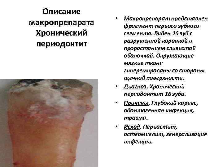   Описание    • Макропрепарат представлен макропрепарата фрагмент первого зубного Хронический