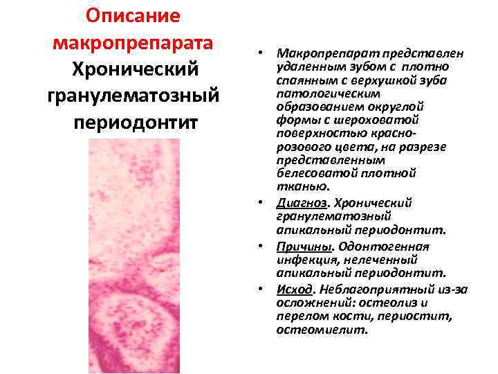   Описание макропрепарата  • Макропрепарат представлен  Хронический удаленным зубом с плотно