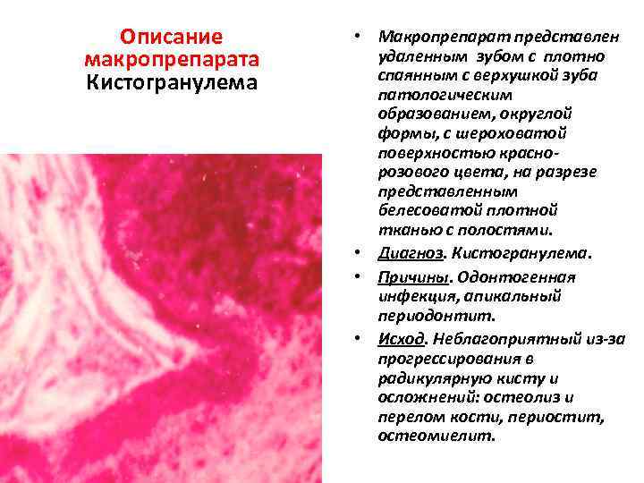 Коклюш патанатомия презентация